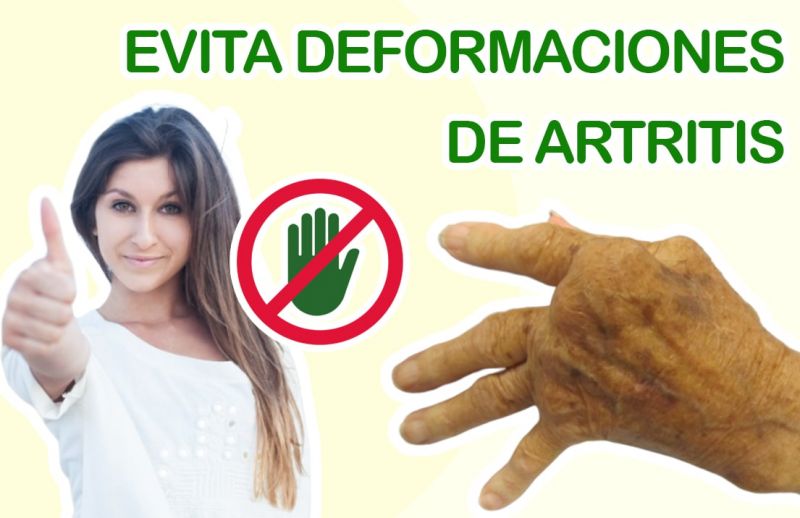 ¿cómo Evitar Deformaciones Por Artritis 5 Consejos Naturales Nuevas Evas