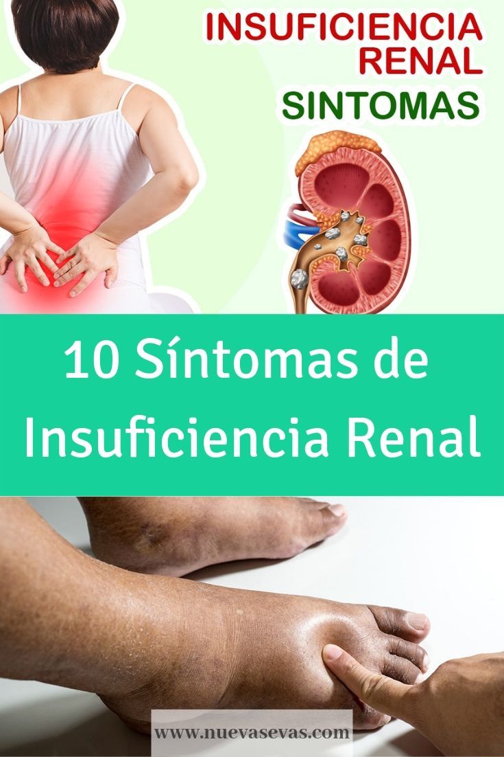 10 Síntomas De Insuficiencia Renal Y Riñones Inflamados Nuevas Evas 8488